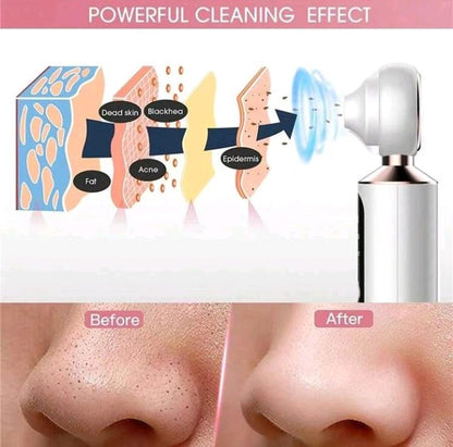 Electric Blackhead Remover